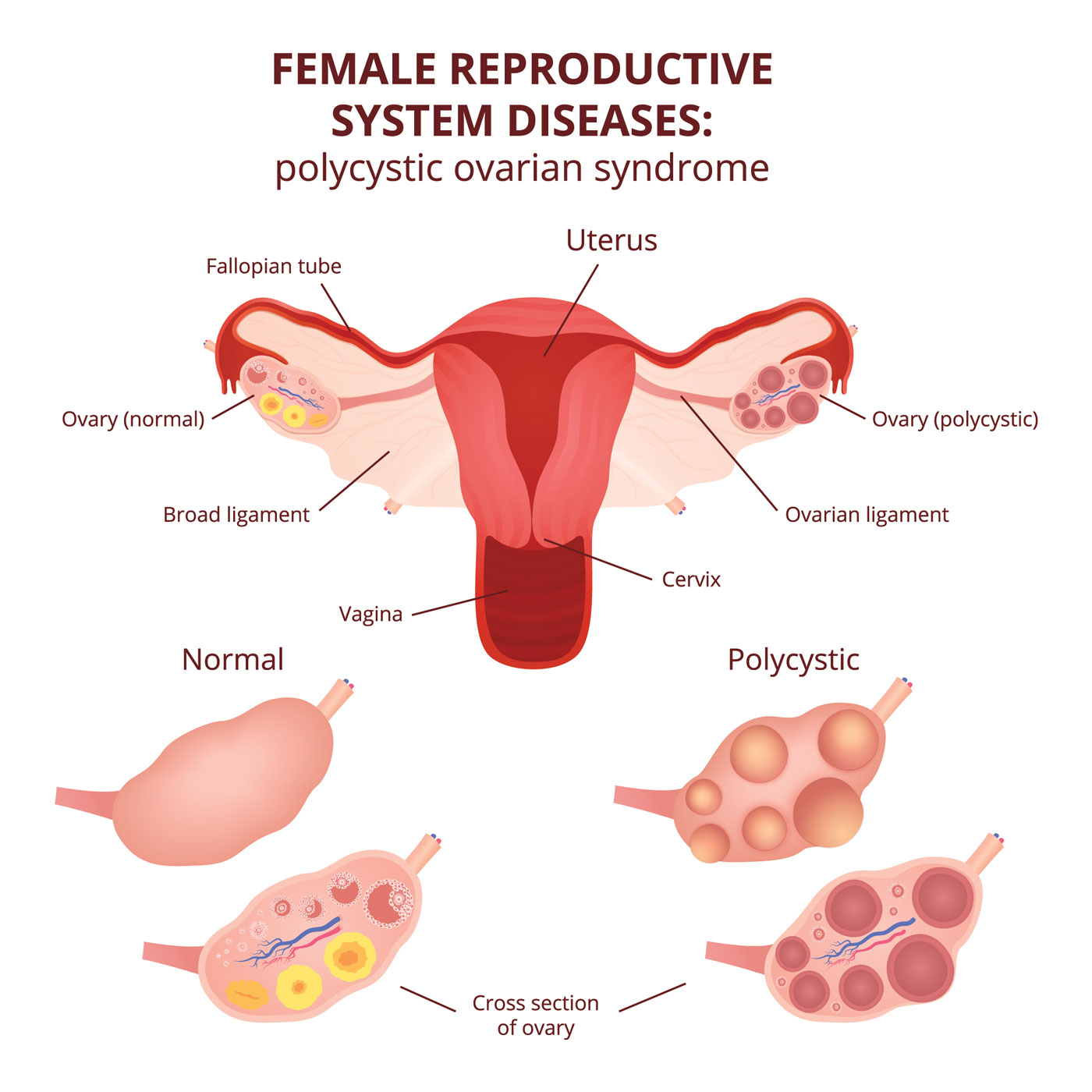 September is Polycystic Ovary Syndrome (PCOS) awareness month