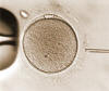 Intracytoplasmic sperm injection (ICSI) procedure performed with precision in the lab.