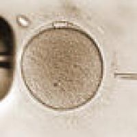 Intracytoplasmic sperm injection (ICSI) procedure performed with precision in the lab.
